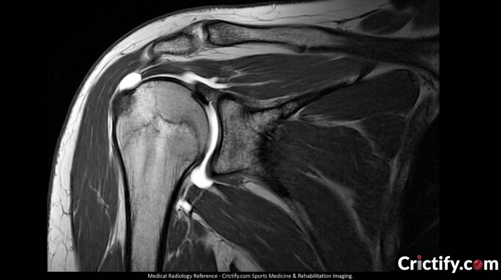 MRI arthrogram image showing SLAP tear with contrast highlighting superior labral detachment, Crictify.com radiology branding