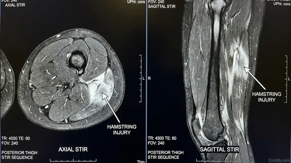 MRI scan of posterior thigh showing hamstring muscle injury with high signal intensity on STIR sequence.